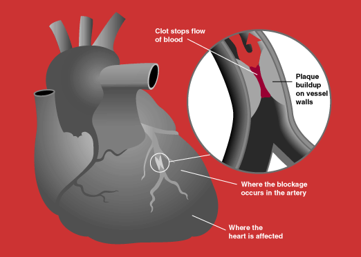 heart_attack_diagram